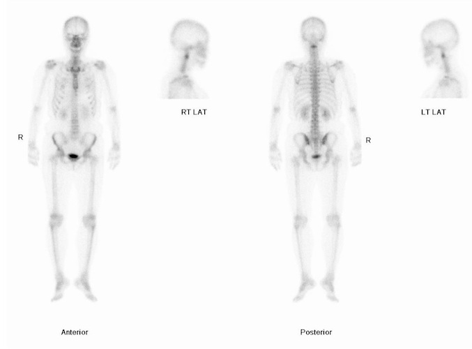 Figure 5 for case fibrous dysplasia ( RID3738 )